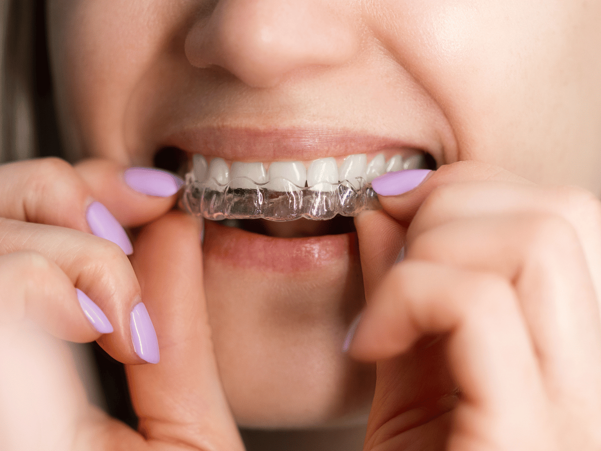 clear aligner