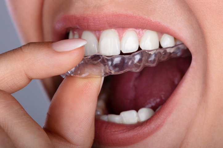 invisalign adult