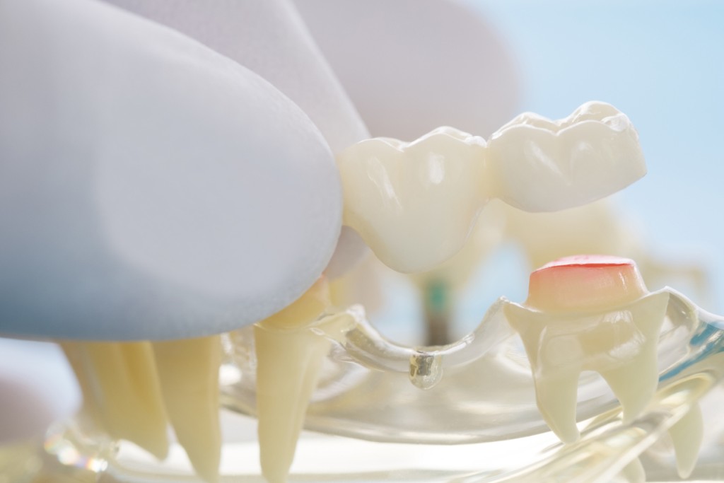 Dental Bridge Process - Family Dental Care